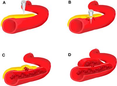 Intracranial Pseudoaneurysms: Evaluation and Management